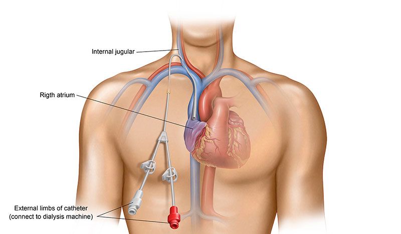 Types of Dialysis Access - Shoals Kidney & Hypertension Center